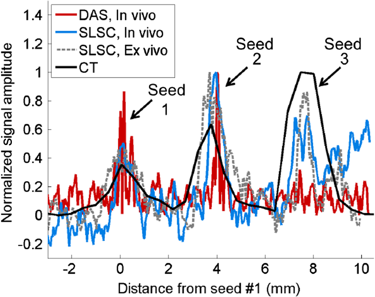 In Vivo Visualization Of Prostate Brachytherapy Seeds With Photoacoustic Imaging 7504