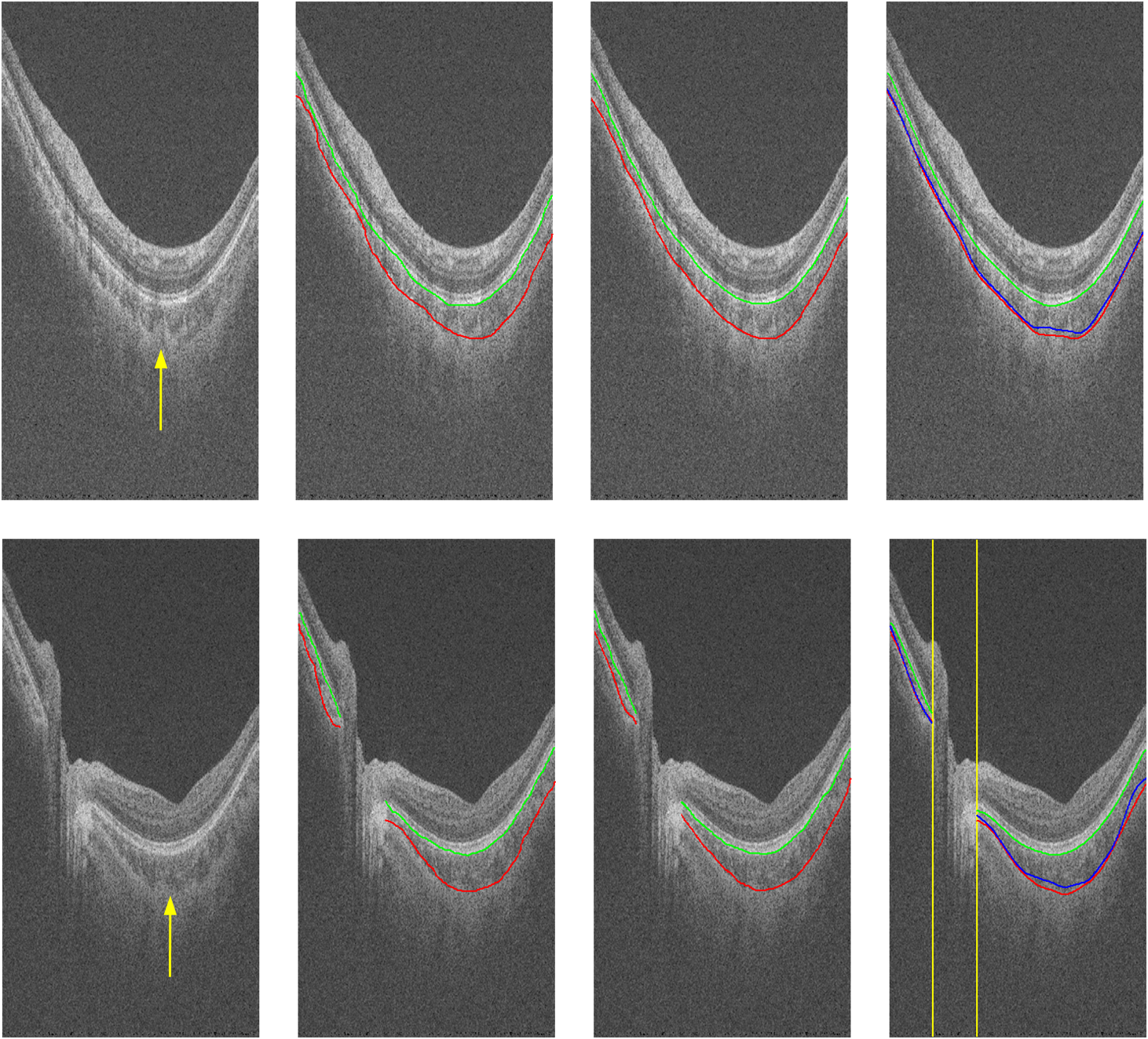 Automated Choroid Segmentation In Three-dimensional 1-μm Wide-view OCT ...