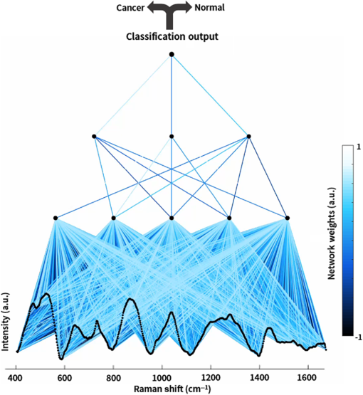 Neural Networks Improve Brain Cancer Detection With Raman - 