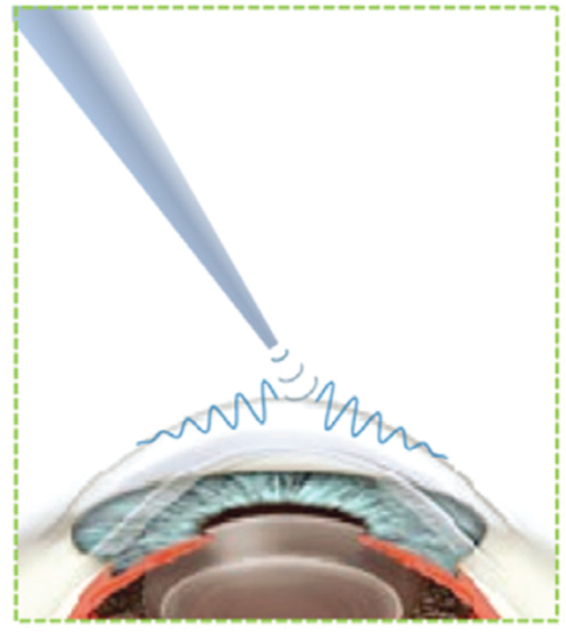 Optical coherence elastography in ophthalmology