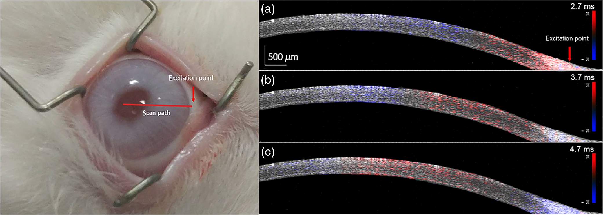 In Vivo Evaluation Of Corneal Biomechanical Properties By Optical ...