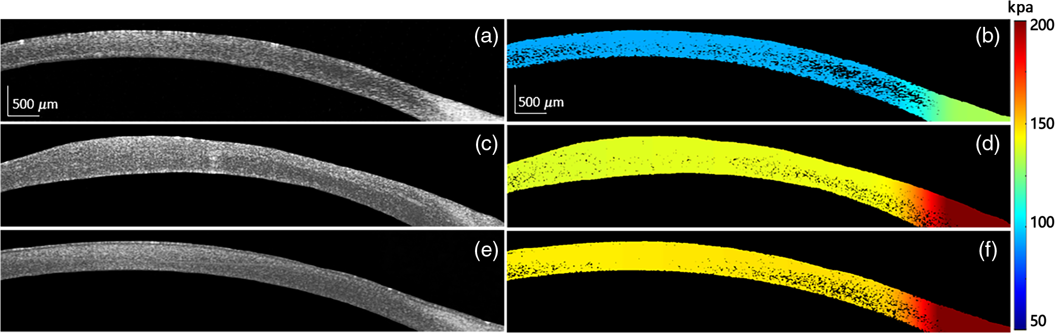 In Vivo Evaluation Of Corneal Biomechanical Properties By Optical ...