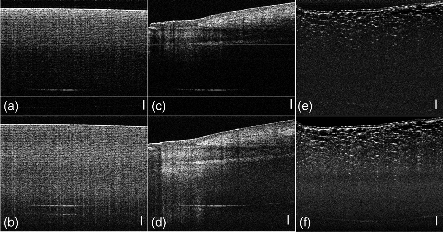 Dynamic Range Compression And Contrast Enhancement In Swept Source Optical Coherence Tomography Systems With A Frequency Gain Compensation Amplifier