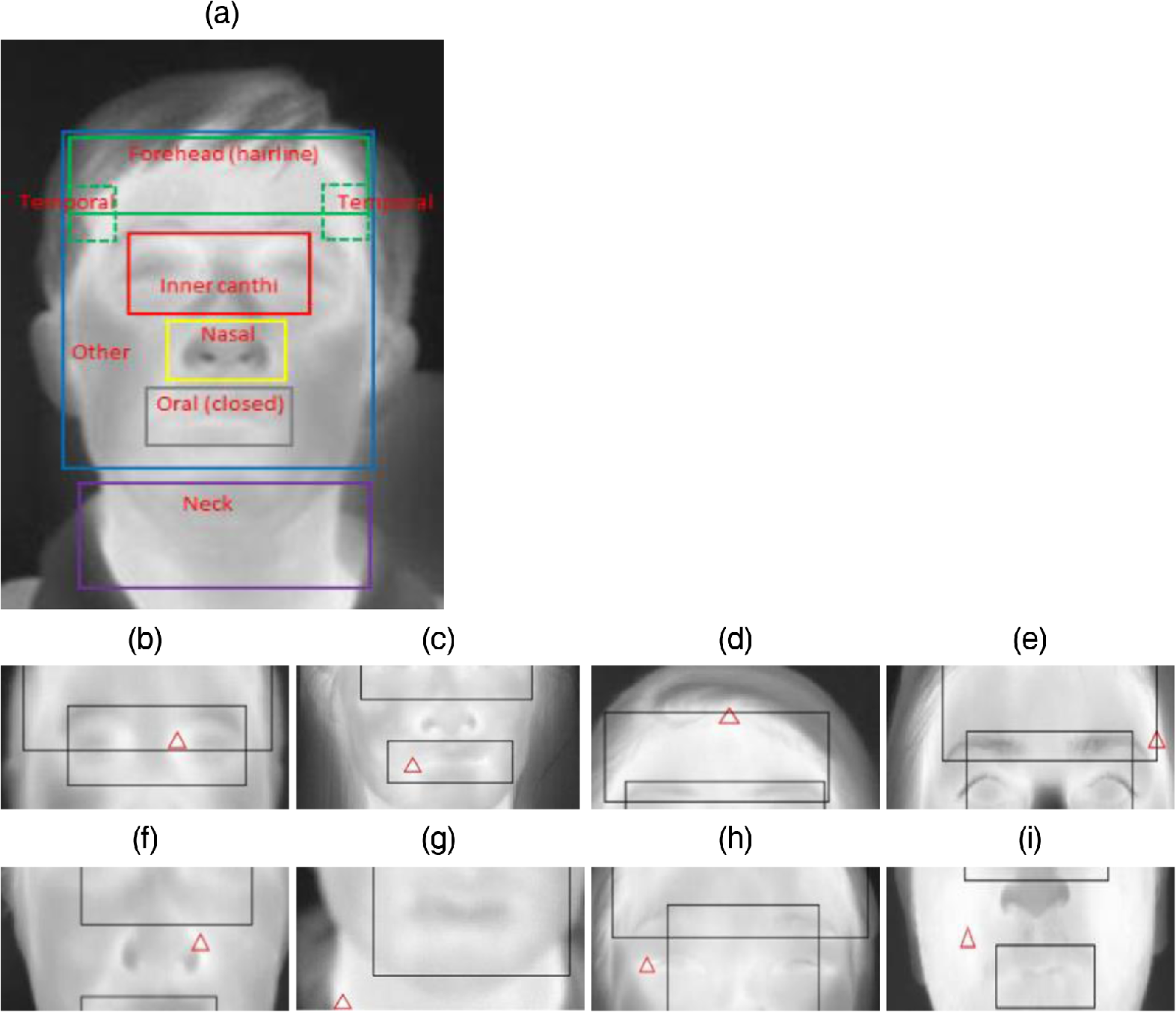 Clinical Evaluation Of Fever Screening Thermography Impact Of Consensus Guidelines And Facial Measurement Location