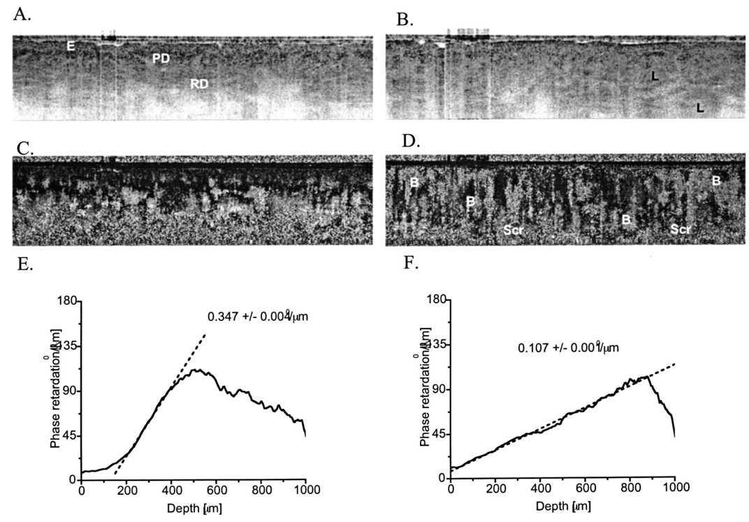 polarization-sensitive-optical-coherence-tomography-of-invasive-basal