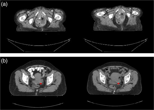 Leveraging Datature Nexus for Tumor and Anomaly Detection in Medical Scans  : Part I