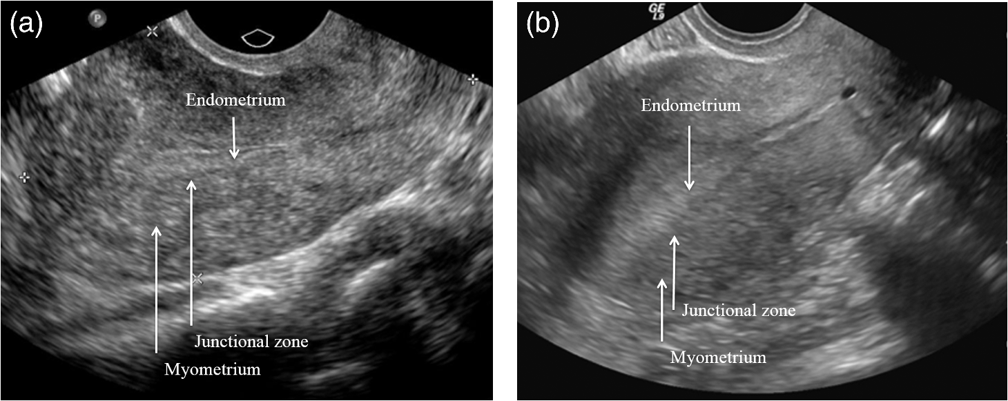 Quantitative Analysis Of Ultrasound Images For Computer Aided Diagnosis