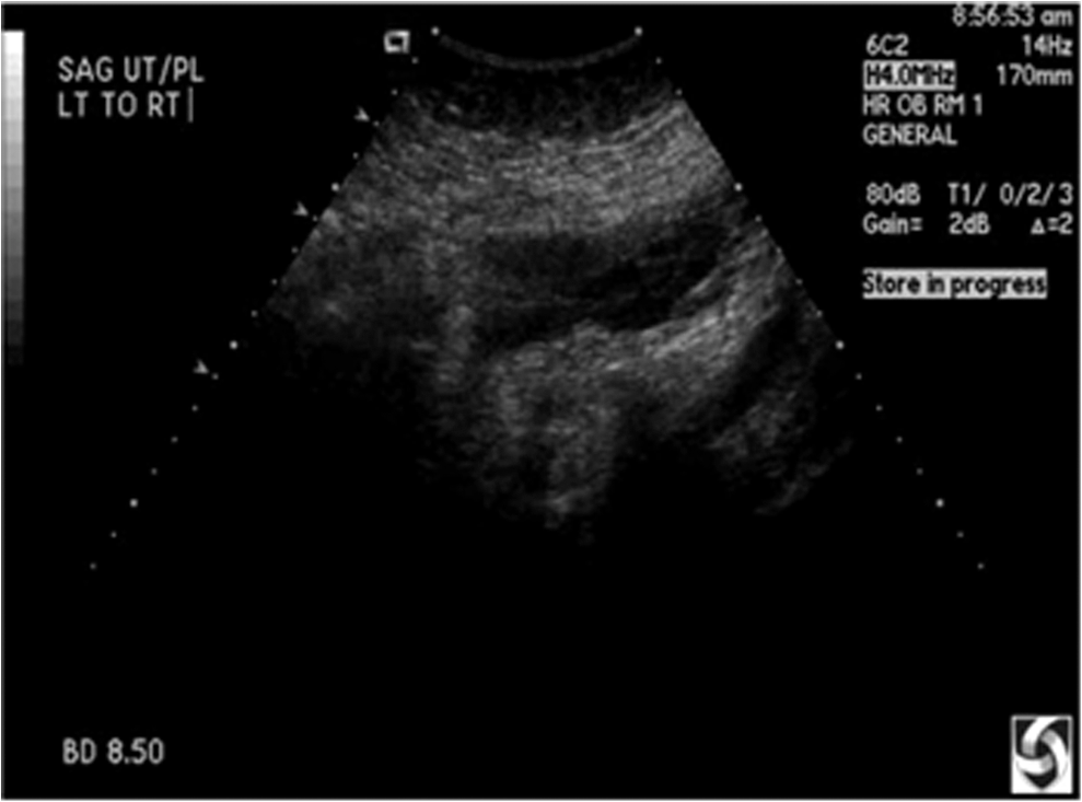 Watermarking Of Ultrasound Medical Images In Teleradiology Using Compressed Watermark