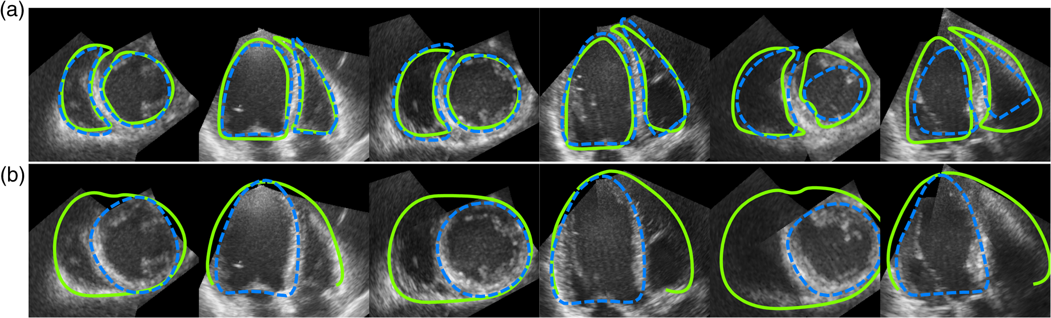 Semiautomated Biventricular Segmentation In Three Dimensional Echocardiography By Coupled Deformable Surfaces