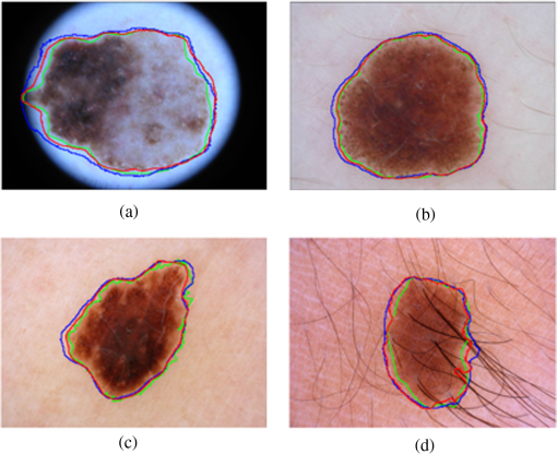 Automatic skin lesion segmentation by coupling deep fully convolutional ...