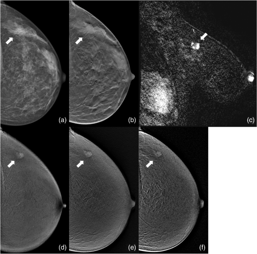 Comparison of contrast-enhanced digital mammography and contrast ...