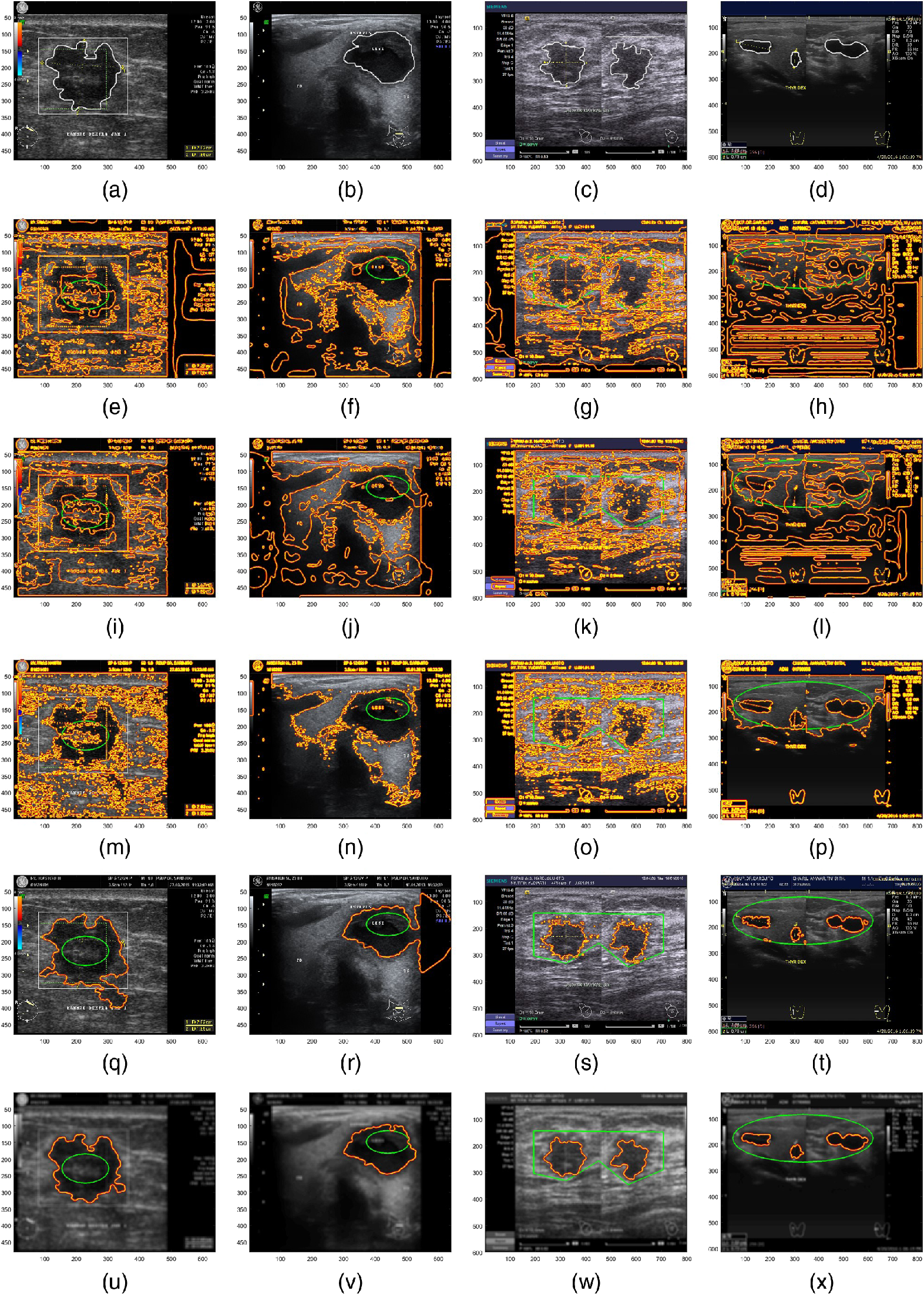 Combinatorial Active Contour Bilateral Filter For Ultrasound Image Segmentation