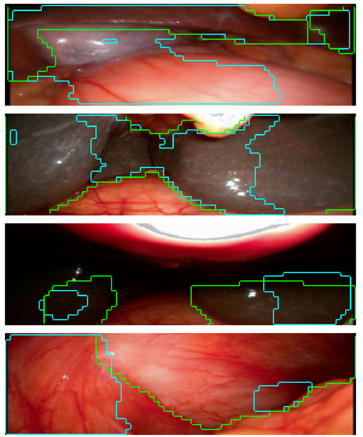 The 3D endoscope: external photography showing the TIPCAMR 1S 3D ORL