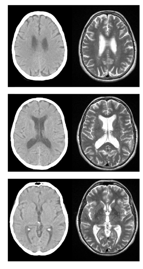 Calculation Of Brain Atrophy Using Computed Tomography And A