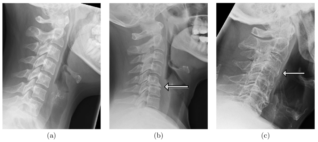 cervical spine x ray