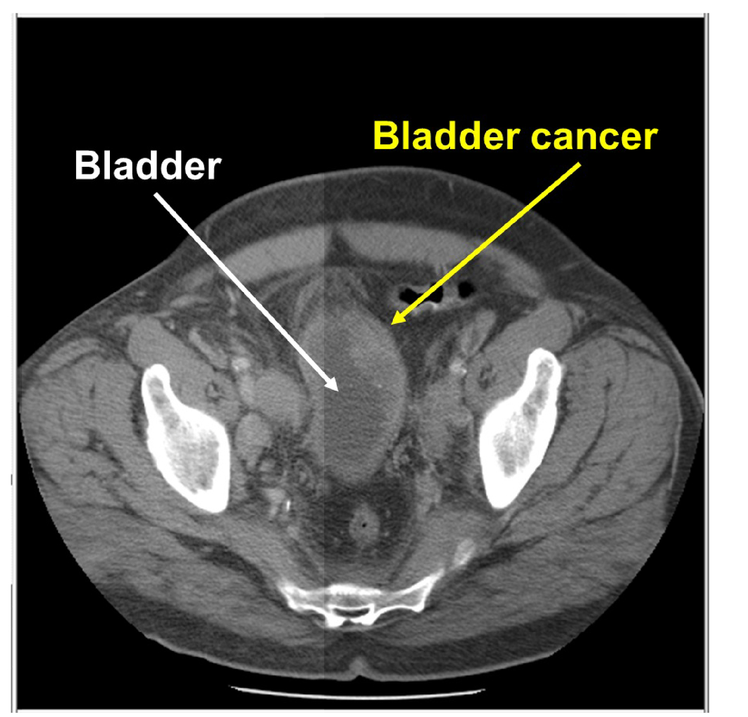 What Does Bladder Cancer Look Like On A Ct Scan Ct Scan Machine My 